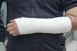 Person with arm cast on